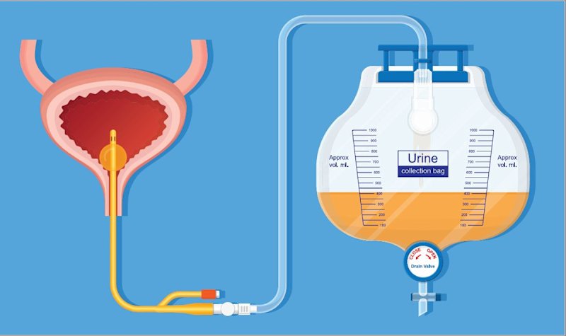 Indwelling Catheters: Insertion and management of short-term catheters