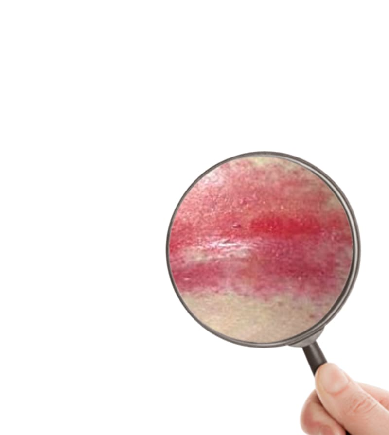 Intertriginous dermatitis: Treatment and nursing care