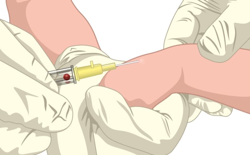 Venepuncture and IV cannulation: Special considerations for children and neonates (3 of 5)
